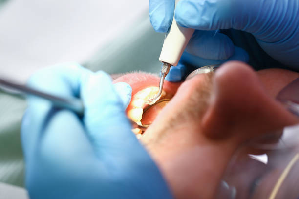 Best Lost Filling or Crown Replacement in St Louis, MI